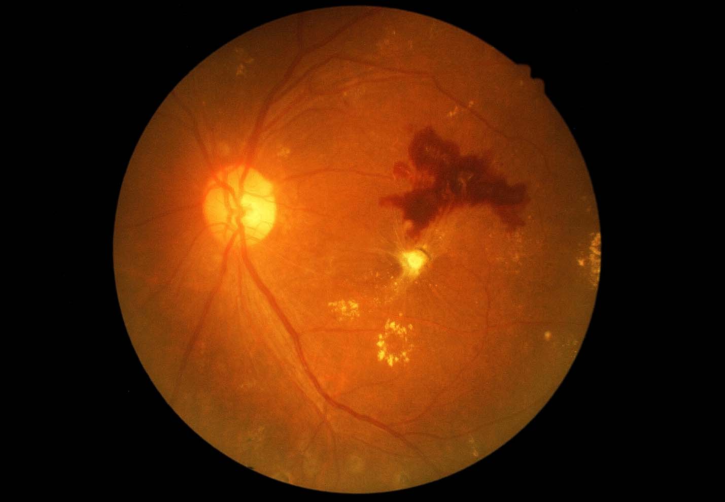 retinopathy